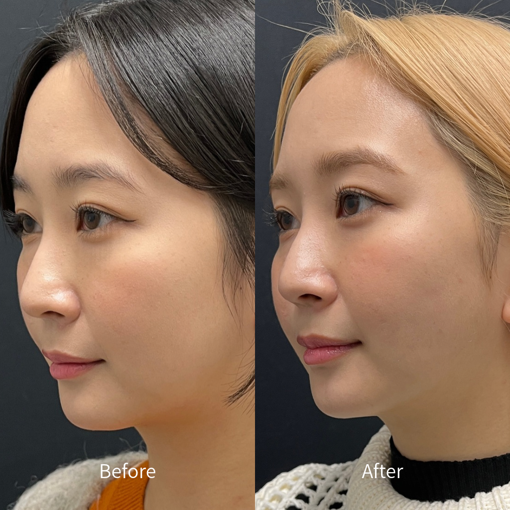 VASER Liposuction case photo